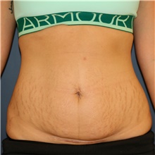 Tummy Tuck Before Photo by Steve Laverson, MD, FACS; Rancho Santa Fe, CA - Case 45403