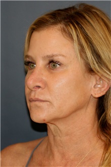 Facelift Before and After Photos  American Society of Plastic Surgeons
