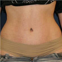 Tummy Tuck After Photo by Steve Laverson, MD, FACS; Rancho Santa Fe, CA - Case 45408