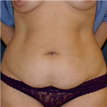 Tummy Tuck Before Photo by Steve Laverson, MD, FACS; Rancho Santa Fe, CA - Case 45408