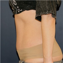 Tummy Tuck After Photo by Steve Laverson, MD, FACS; Rancho Santa Fe, CA - Case 45408