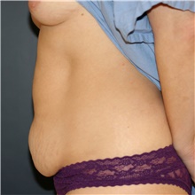 Tummy Tuck Before Photo by Steve Laverson, MD, FACS; Rancho Santa Fe, CA - Case 45408