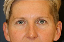 Brow Lift Before Photo by Steve Laverson, MD; San Diego, CA - Case 45489