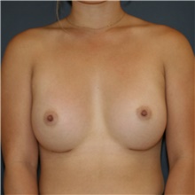 Breast Augmentation After Photo by Steve Laverson, MD, FACS; Rancho Santa Fe, CA - Case 45555