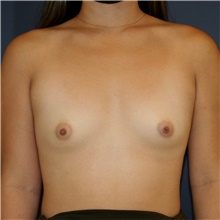 Breast Augmentation Before Photo by Steve Laverson, MD, FACS; Rancho Santa Fe, CA - Case 45555