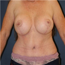 Mommy Makeover After Photo by Steve Laverson, MD, FACS; Rancho Santa Fe, CA - Case 45680