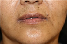 Lip Augmentation/Enhancement After Photo by Steve Laverson, MD, FACS; Rancho Santa Fe, CA - Case 45684