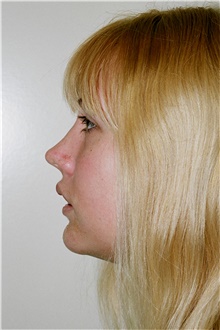 Chin Augmentation After Photo by Steve Laverson, MD, FACS; San Diego, CA - Case 45711