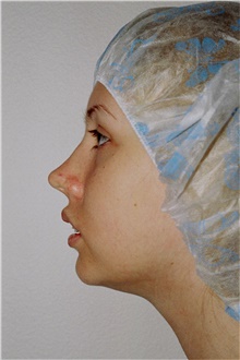 Chin Augmentation Before Photo by Steve Laverson, MD; San Diego, CA - Case 45711