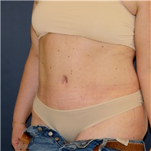 Tummy Tuck After Photo by Steve Laverson, MD, FACS; Rancho Santa Fe, CA - Case 45845