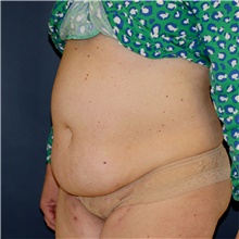 Tummy Tuck Before Photo by Steve Laverson, MD, FACS; Rancho Santa Fe, CA - Case 45845