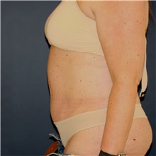 Tummy Tuck After Photo by Steve Laverson, MD, FACS; Rancho Santa Fe, CA - Case 45845