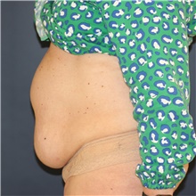 Tummy Tuck Before Photo by Steve Laverson, MD, FACS; Rancho Santa Fe, CA - Case 45845