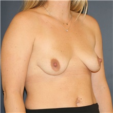 Breast Lift Before Photo by Steve Laverson, MD, FACS; Rancho Santa Fe, CA - Case 45864