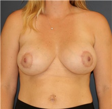 Breast Lift After Photo by Steve Laverson, MD, FACS; Rancho Santa Fe, CA - Case 45864
