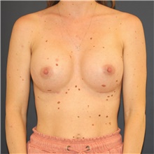 Breast Augmentation After Photo by Steve Laverson, MD, FACS; Rancho Santa Fe, CA - Case 45935