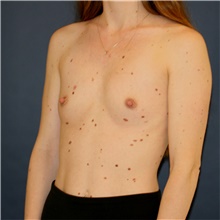 Breast Augmentation Before Photo by Steve Laverson, MD, FACS; Rancho Santa Fe, CA - Case 45935