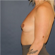 Breast Augmentation Before Photo by Steve Laverson, MD, FACS; Rancho Santa Fe, CA - Case 45996