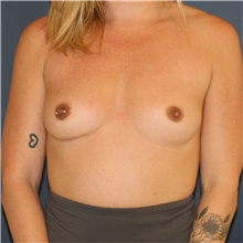 Breast Augmentation Before Photo by Steve Laverson, MD, FACS; Rancho Santa Fe, CA - Case 45996