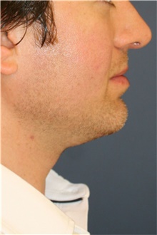 Chin Augmentation After Photo by Steve Laverson, MD; San Diego, CA - Case 45998