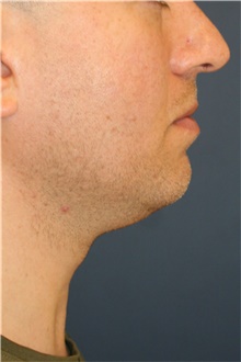 Chin Augmentation Before Photo by Steve Laverson, MD, FACS; Rancho Santa Fe, CA - Case 45998