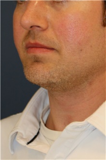 Chin Augmentation After Photo by Steve Laverson, MD, FACS; Rancho Santa Fe, CA - Case 45998
