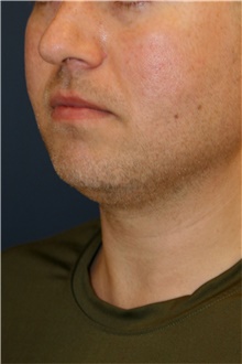 Chin Augmentation Before Photo by Steve Laverson, MD, FACS; Rancho Santa Fe, CA - Case 45998