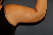 Arm Lift Before and After Photos  American Society of Plastic Surgeons