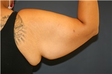 Arm Lift Before Photo by Steve Laverson, MD, FACS; Rancho Santa Fe, CA - Case 46001