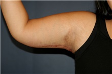 Arm Lift After Photo by Steve Laverson, MD, FACS; San Diego, CA - Case 46001