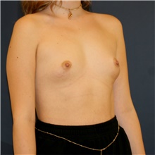 Breast Augmentation Before Photo by Steve Laverson, MD, FACS; Rancho Santa Fe, CA - Case 46002