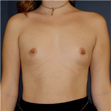 Breast Augmentation Before Photo by Steve Laverson, MD, FACS; Rancho Santa Fe, CA - Case 46002