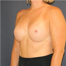 Breast Augmentation After Photo by Steve Laverson, MD, FACS; Rancho Santa Fe, CA - Case 46189