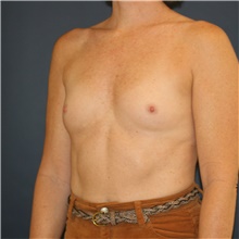 Breast Augmentation Before Photo by Steve Laverson, MD, FACS; Rancho Santa Fe, CA - Case 46189