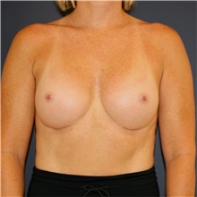 Breast Augmentation After Photo by Steve Laverson, MD, FACS; Rancho Santa Fe, CA - Case 46189