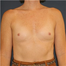 Breast Augmentation Before Photo by Steve Laverson, MD, FACS; Rancho Santa Fe, CA - Case 46189