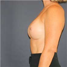Breast Augmentation After Photo by Steve Laverson, MD, FACS; Rancho Santa Fe, CA - Case 46189