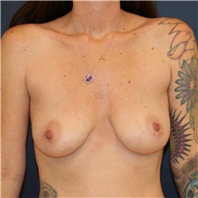 Breast Lift Before Photo by Steve Laverson, MD, FACS; Rancho Santa Fe, CA - Case 46199