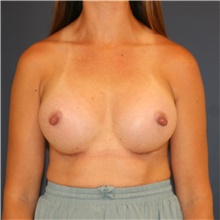 Breast Augmentation After Photo by Steve Laverson, MD, FACS; Rancho Santa Fe, CA - Case 46200