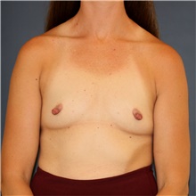 Breast Augmentation Before Photo by Steve Laverson, MD, FACS; Rancho Santa Fe, CA - Case 46200