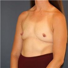 Breast Augmentation Before Photo by Steve Laverson, MD, FACS; Rancho Santa Fe, CA - Case 46200