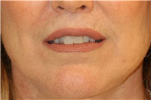 Lip Augmentation/Enhancement After Photo by Steve Laverson, MD, FACS; Rancho Santa Fe, CA - Case 46204