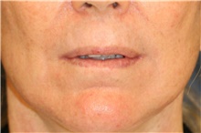 Lip Augmentation/Enhancement Before Photo by Steve Laverson, MD, FACS; Rancho Santa Fe, CA - Case 46204