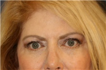 Brow Lift After Photo by Steve Laverson, MD, FACS; San Diego, CA - Case 46205