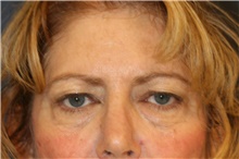 Brow Lift Before Photo by Steve Laverson, MD, FACS; Rancho Santa Fe, CA - Case 46205