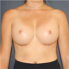 Breast Augmentation After Photo by Steve Laverson, MD, FACS; Rancho Santa Fe, CA - Case 46206