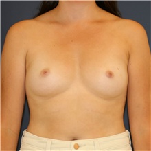 Breast Augmentation Before Photo by Steve Laverson, MD, FACS; Rancho Santa Fe, CA - Case 46206