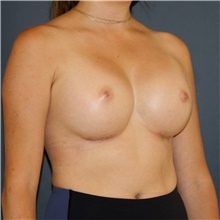 Breast Augmentation After Photo by Steve Laverson, MD, FACS; Rancho Santa Fe, CA - Case 46206