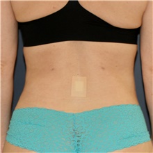 Liposuction After Photo by Steve Laverson, MD, FACS; Rancho Santa Fe, CA - Case 46241