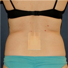 Liposuction Before Photo by Steve Laverson, MD, FACS; San Diego, CA - Case 46241